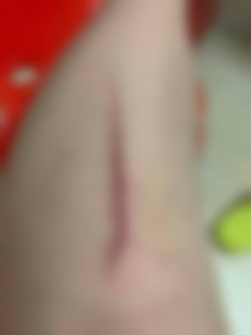 长了疤痕疙瘩怎么办？认识郑州第二中医院池秀红医生的疤痕疙瘩治疗