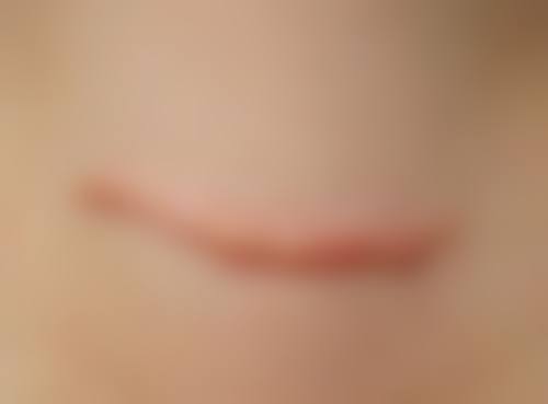 甲状腺手术后有疤痕增生怎么办？各医院综合点评