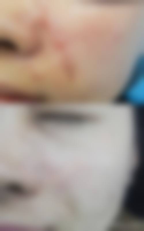 割双眼皮开眼角增生多久可以修复——武汉亚韩整形外科医院