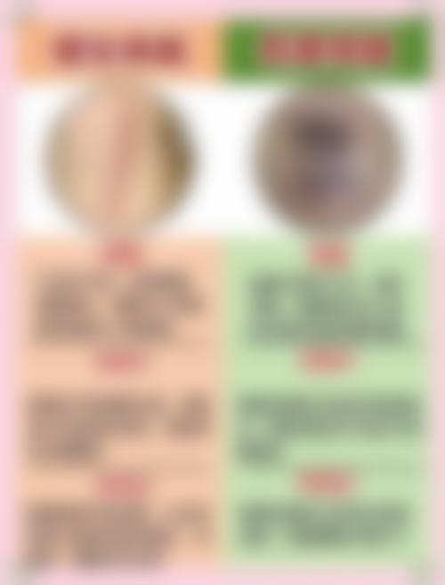 长了疤痕疙瘩怎么办？探究上海9院黄埔分院韩东亮医生的疤痕疙瘩治疗