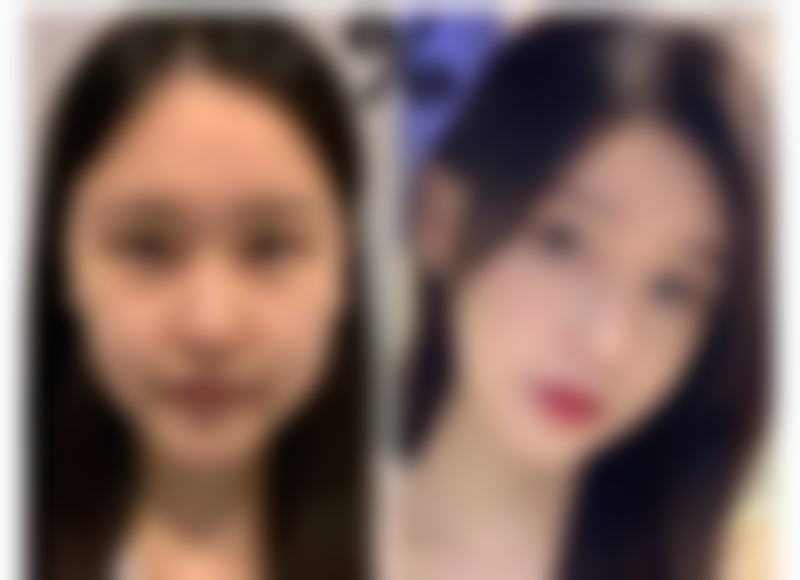 血压高能做眼袋手术吗之术前准备