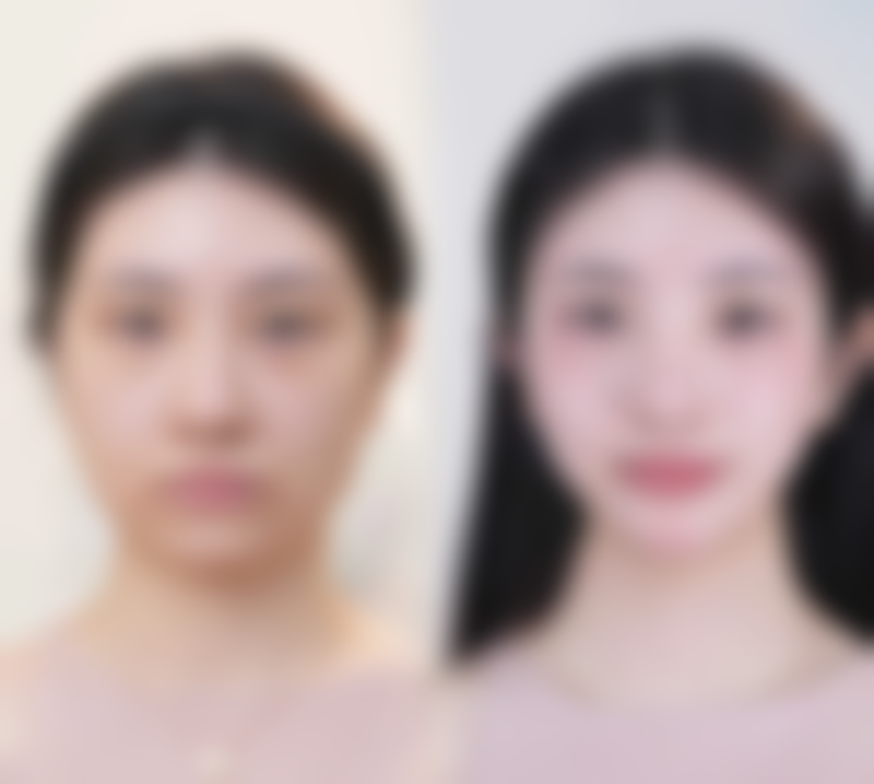 婴儿烫伤疤痕增生多久消除——合肥华美