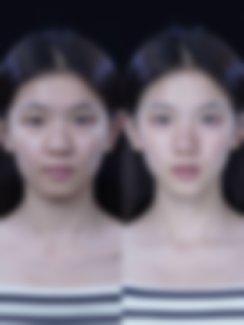 宝宝脸上的冻疮疤痕怎么去除之把握至佳治疗时间