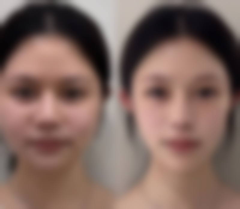 全切双眼皮有疤痕要注意什么：5个“千万不能”