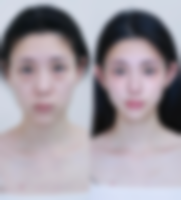 抽脂不同部位多久可以泡温泉：精细把握修复节奏