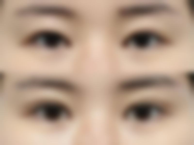 除眼袋什么方法更安心更好——西安雁塔华旗唯美门诊部