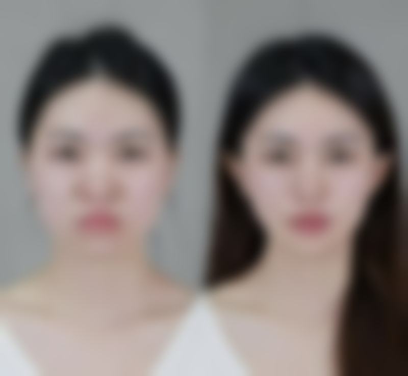 双眼皮怎么去除肉条感：医院医生怎么选？这份指南请收好