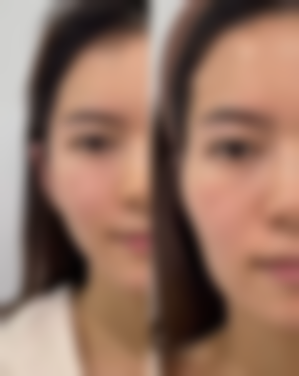 做双眼皮有必要提肌吗:不同医院的选择考量