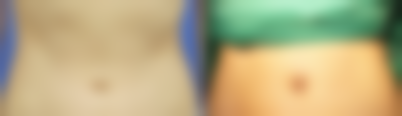 血压高能做眼袋手术吗之医院选择