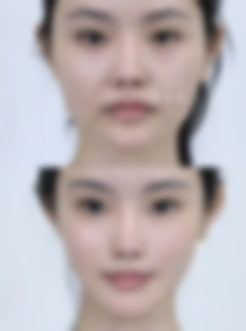 血压高能做眼袋手术吗之达标条件