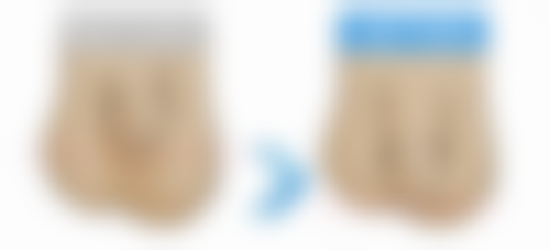 手术隆鼻与其他方式的比较：持久与便捷的权衡