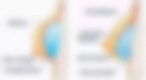 北京国有医院全切双眼皮技术与特色分析