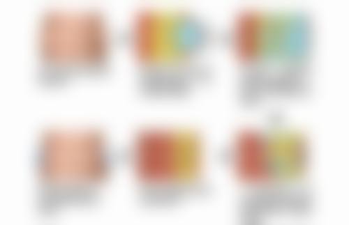 自体软骨隆鼻修复期：半个月到一个月