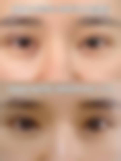 用鸡蛋滚眼睛可以去眼袋吗——YY医院