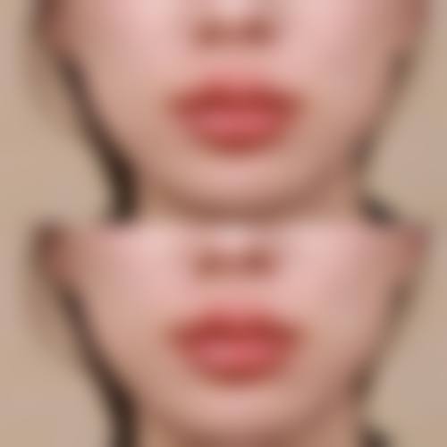 广州深圳健丽眼袋医院——不开刀去眼袋的按摩特色