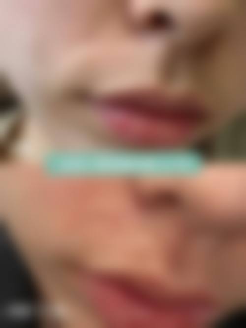 眼袋手术后有疤痕怎么办?郑州美艺整形医疗美容诊所解忧愁