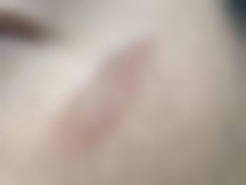 怎么样修复痘痘疤痕——杭州市第三人民医院皮肤科