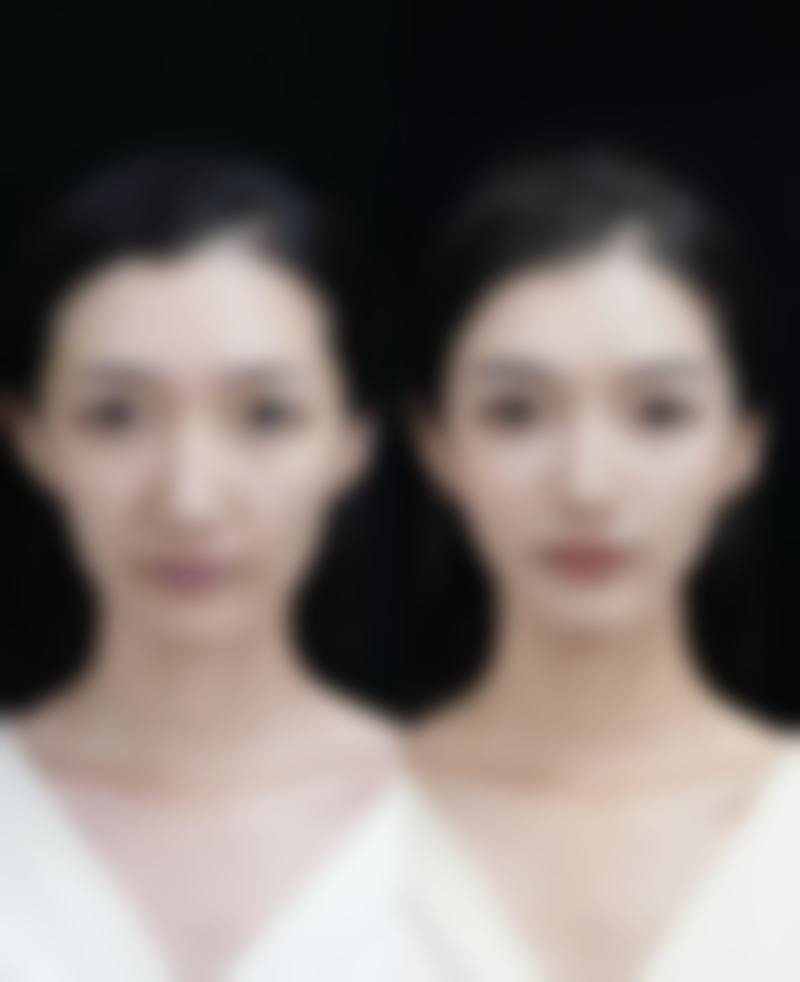 怎么样修复痘痘疤痕？点阵激光+丽珠兰蓝盒，精准修复痘坑痘印