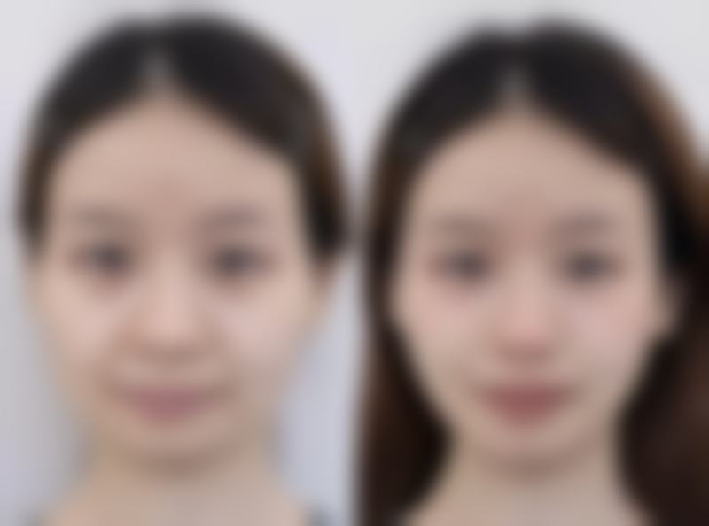 全切双眼皮常见QA问题解答