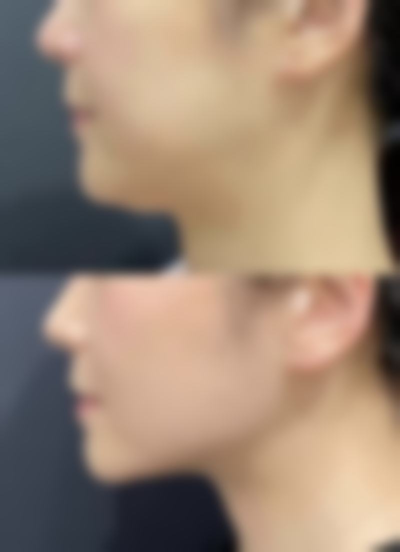 私立医院全身抽脂特色——舒适与个性化