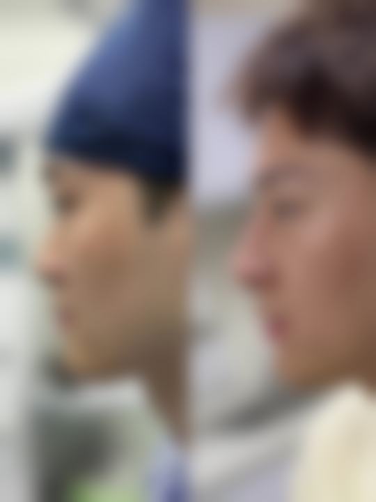 打针隆鼻用什么材料——上海铂诗玥医疗美容