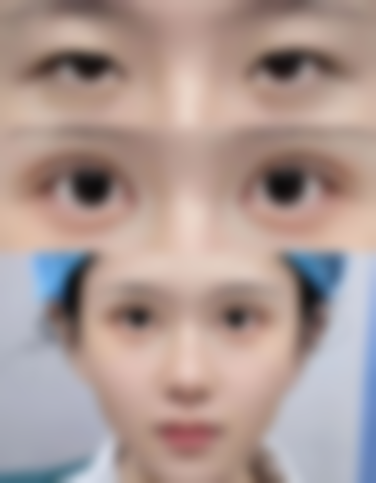 广州美恩医疗美容——“男士医美日”优惠的去眼袋热门选择