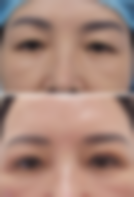 怎么按摩消除眼袋？穴位按摩+刮痧按摩超专业实操手法全解析