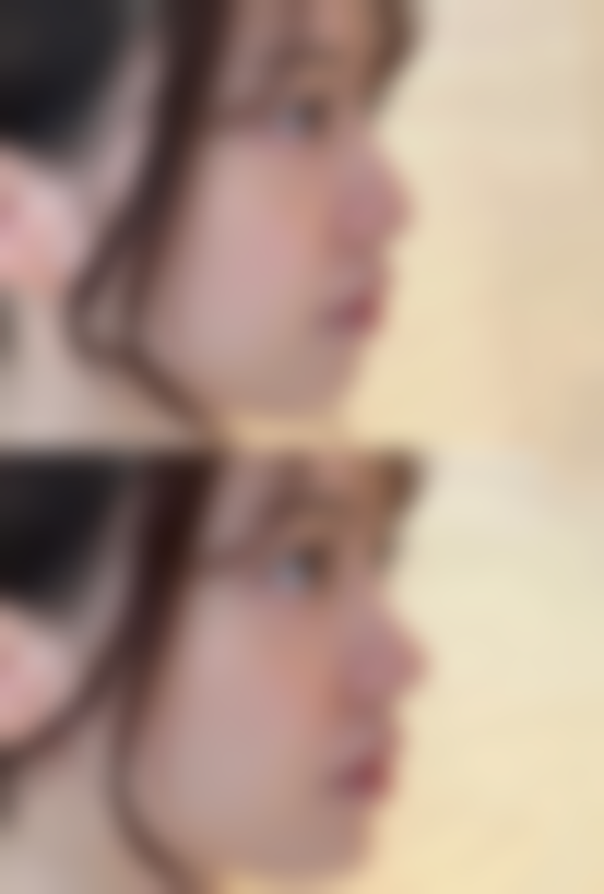 怎么样修复痘痘疤痕——重庆东上医疗美容门诊部