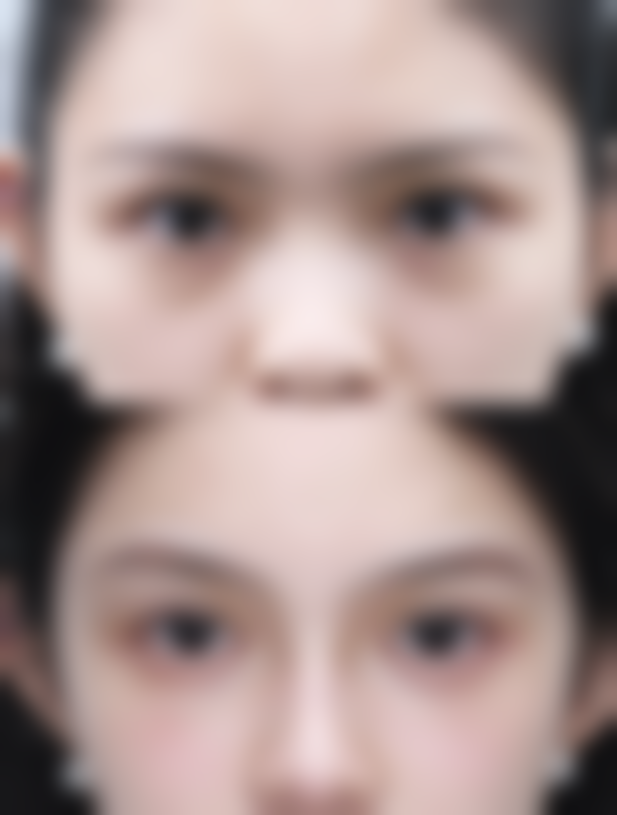 早上起来眼睛浮肿眼袋大，如何防“肿”于未然