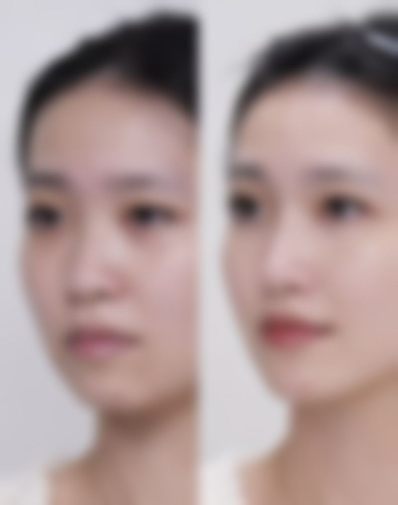 打针隆鼻用什么材料——成都铜雀台