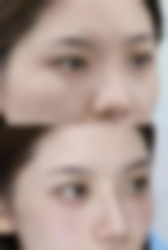 做去眼袋手术注意什么之饮食注意:合理饮食促进修复