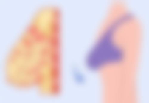 自体脂肪隆胸第二次手术等待3 - 6个月的科学依据