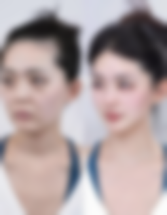 腰腹抽脂多久才能消肿及修复阶段