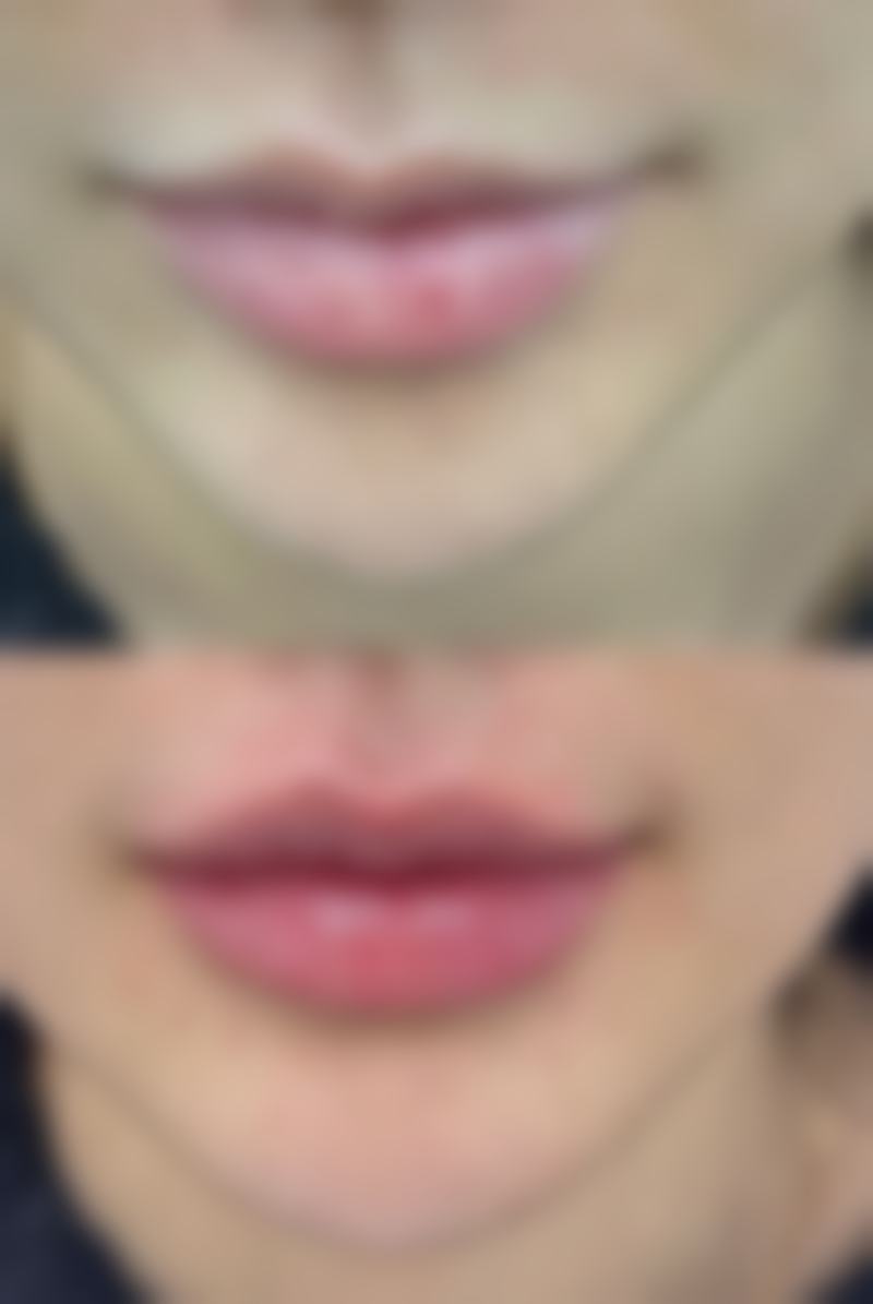 大腿抽脂多久才能消肿及影响因素