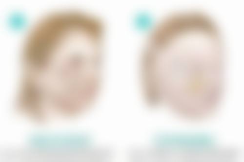 爱贝芙隆鼻是恒久的吗？为何有些成效并非恒久