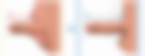 大腿吸脂修复速度的个体差异