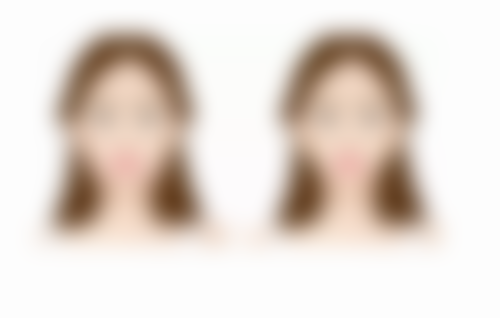 怎么可以让三眼皮变回双眼皮——广州新市医院