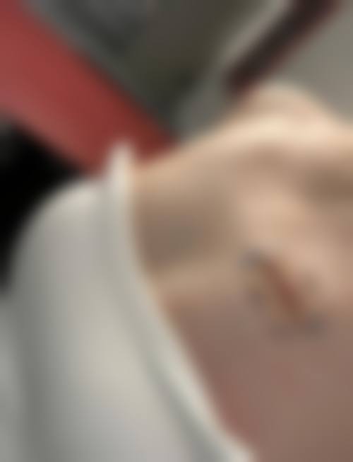 咬伤疤痕怎么去除？药物治疗+激光修复帮你有效改善瘢痕外观