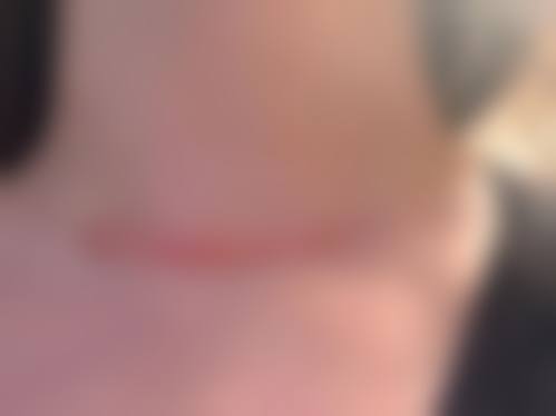 手术疤痕怎么才能淡化掉——武汉中天医疗整形美容门诊部