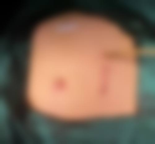 手术疤痕怎么才能淡化掉——武汉天后医疗美容医院