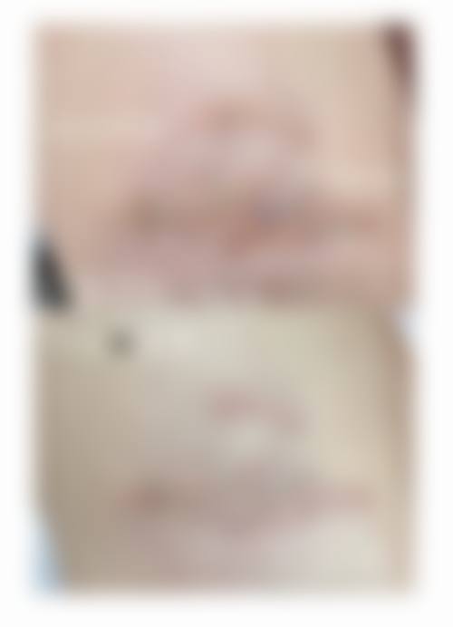 手术疤痕怎么才能淡化掉？武晓莉领衔 军建广药三院祛疤方案解析