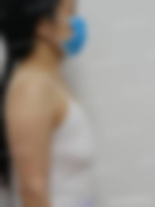 自体脂肪移植隆胸的成效好吗——台州路桥颂妍医疗美容诊所详解