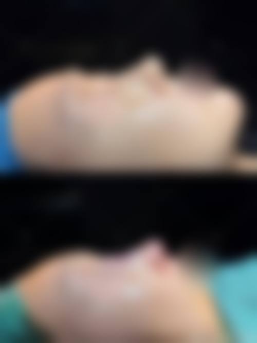 耳软骨隆鼻需要住院吗——西安国医美容外科