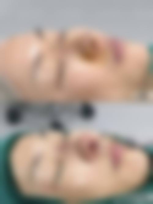 耳软骨隆鼻需要住院吗——青岛赵宏武医学美容门诊部