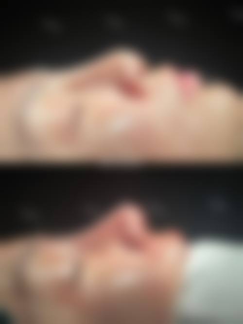 耳软骨隆鼻需要住院吗？不同医师机构住院时长及收费明细解析