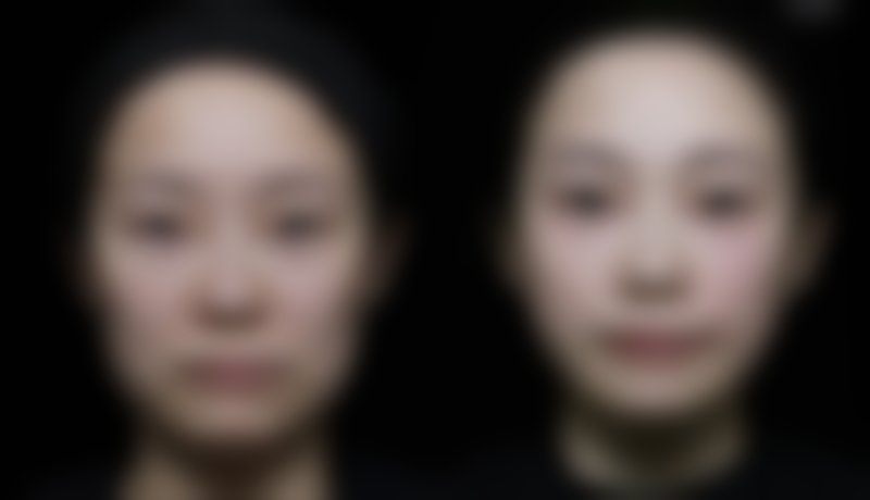 割双眼皮喝豆浆有助于修复吗：营养成分大揭秘，豆浆助力焕新