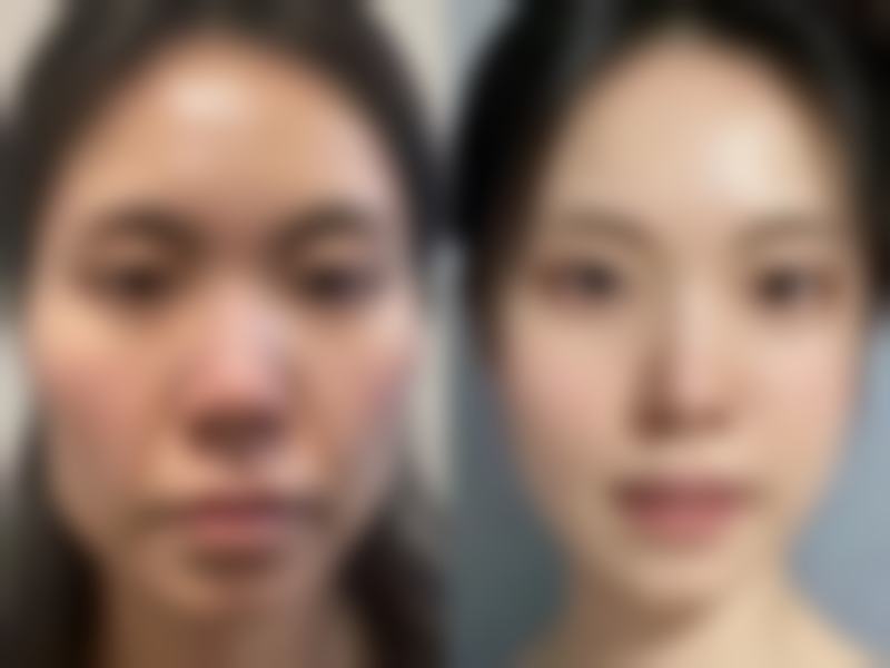 处女膜修复手术：医院保护与术后护理对疤痕的影响