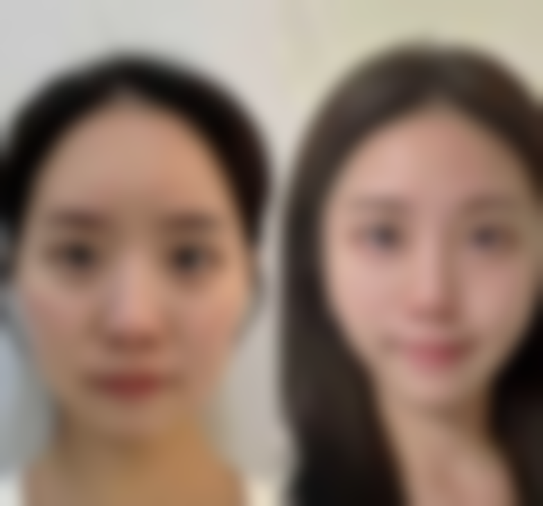 去除黑眼袋用什么——北京美诗沁医疗美容医院