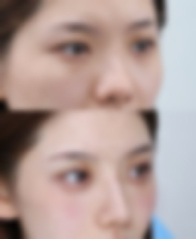 怎么可以让三眼皮变回双眼皮：手术修复与日常护理，陈小剑等支招