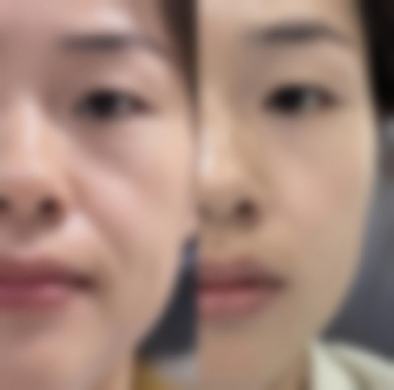 大腿吸脂术后1个月修复期的其他关键点